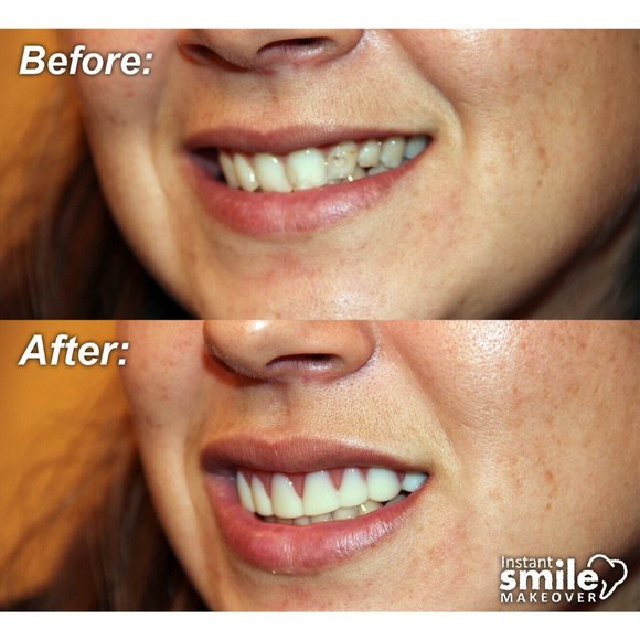 Instant Smile Makeover Comfort Flex Fit Top Upper Veneers - Natural Shade - Picture 6 of 6